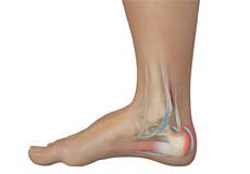 Achilles Tendon Bursitis