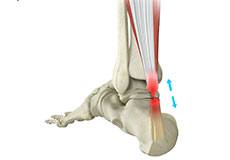 Achilles Tendon Repair