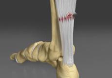 Achilles Tendon injuries