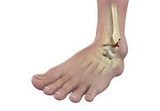 Ankle Fractures