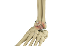 Ankle Fusion