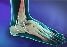 Ankle Ligament Injury