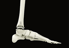 Ankle Replacement
