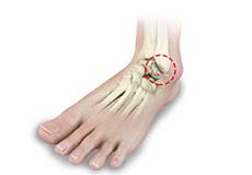 Foot and Ankle Arthritis